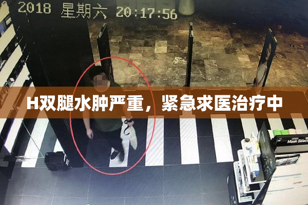 H双腿水肿严重，紧急求医治疗中